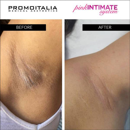 Promoitalia Système Intime Rose